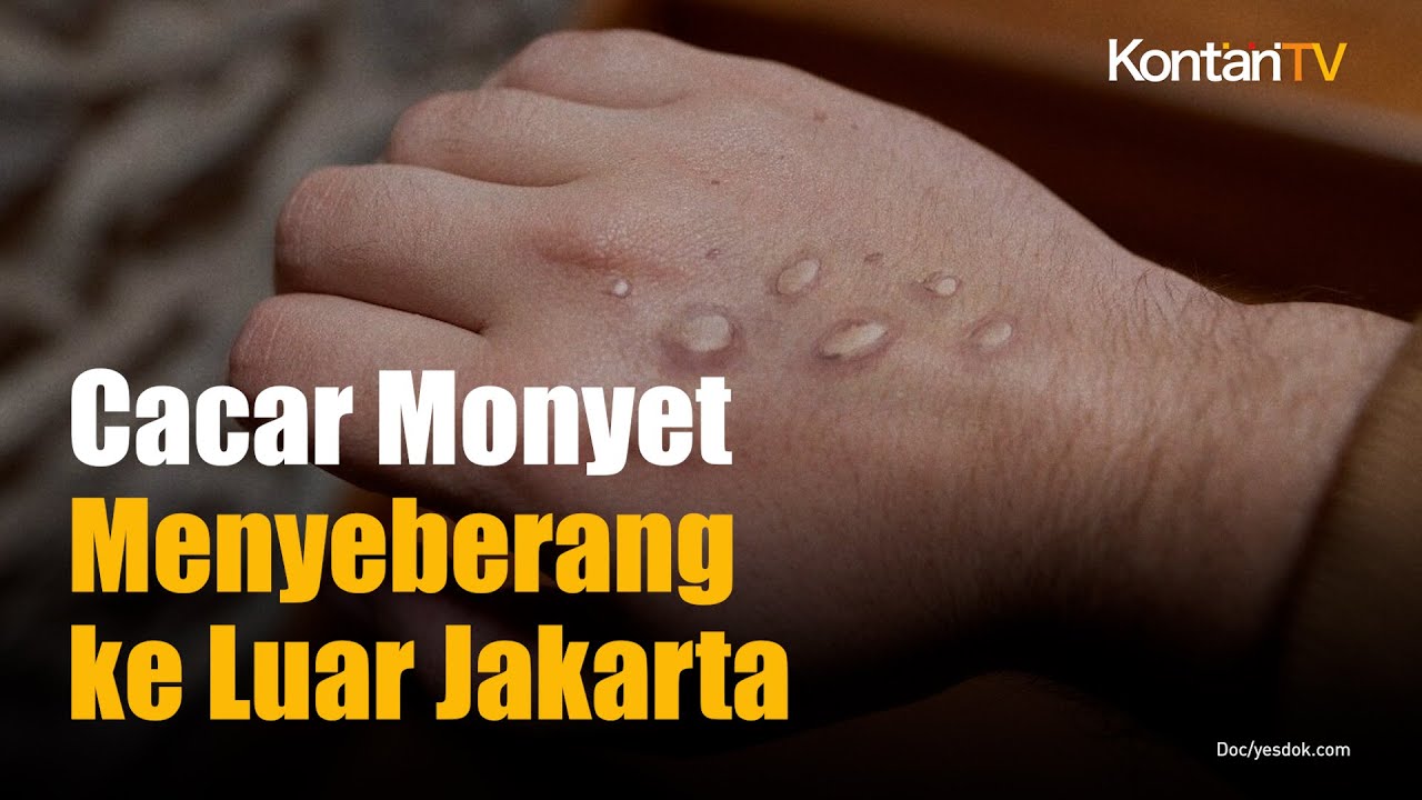 Cacar Monyet Sudah Menyeberang ke Luar Jakarta, Kini ada 27 Kasus | KONTAN News