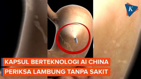 Keajaiban Medis China: Kapsul Berteknologi AI Periksa Lambung Tanpa Rasa Sakit, 8 Menit Selesai