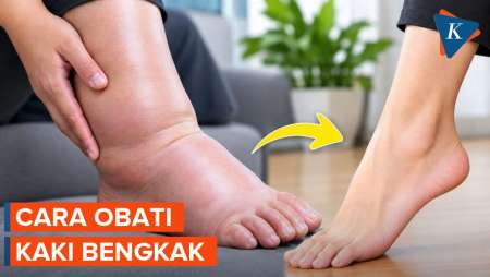 Cara Atasi Kaki Bengkak Sesuai Penyebabnya
