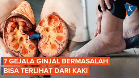 Kenali 7 Gejala Awal Ginjal Bermasalah, Bisa Terlihat dari Kaki dan Mata