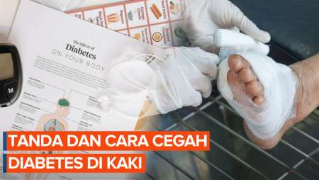 Tanda-tanda Diabetes di Kaki, Bisa Berujung Amputasi