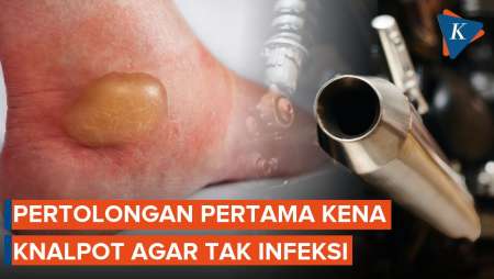 Pertolongan Pertama Kena Knalpot, Lakukan 7 Cara Ini Agar Tak Infeksi