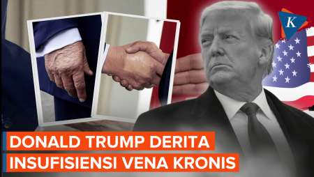  Trump Derita Insufisiensi Vena Kronis, Apa Itu?