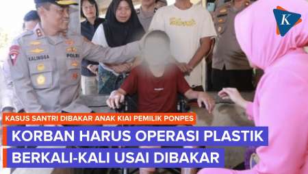 ​Pilu, Santri Yang Dibakar Anak Pemilik Ponpes Lombok Harus Operasi Plastik 4 Kali Lagi