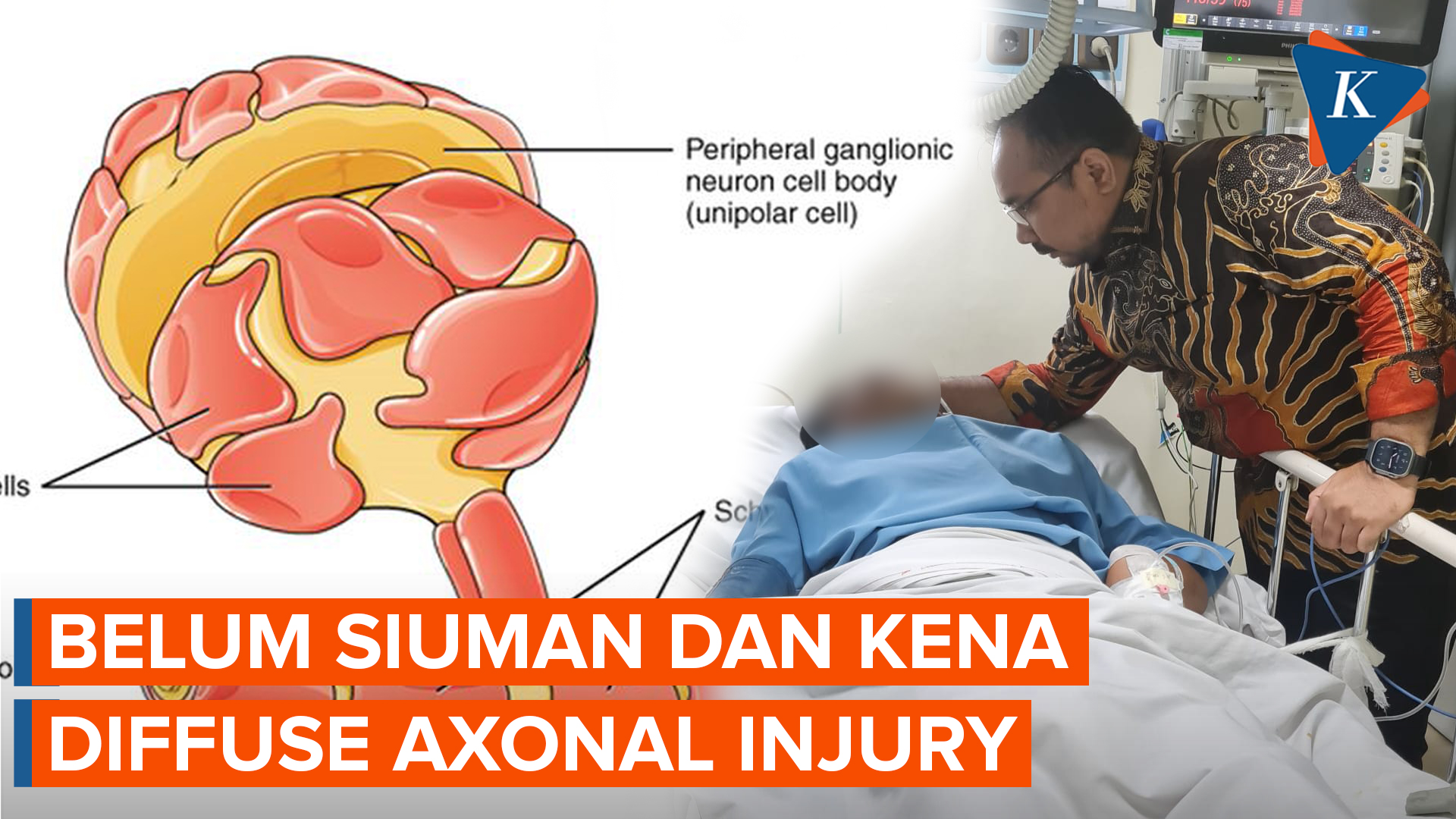 Anak Pengurus GP Ansor yang Dianiaya Mario Dandy Alami Diffuse Axonal Injury