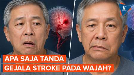 Gejala Stroke Pada Wajah, Ini Tandanya