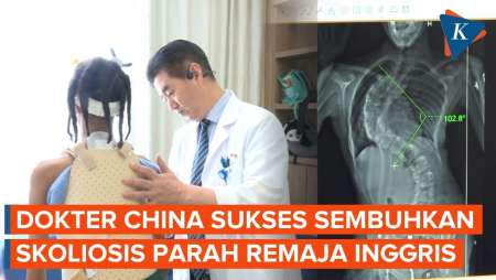 Dokter China Bikin Remaja Inggris Lebih Tinggi 8 Cm Usai Operasi Skoliosis