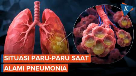 Apa yang Terjadi di Paru-paru saat Pneumonia?