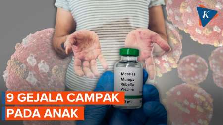 Waspada! Gejala Campak Pada Anak, Jangan Diabaikan!