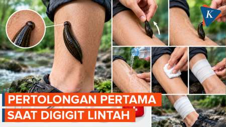 Pertolongan Pertama Saat Digigit Lintah