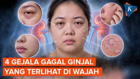 Ciri-ciri Gagal Ginjal yang Tampak pada Wajah