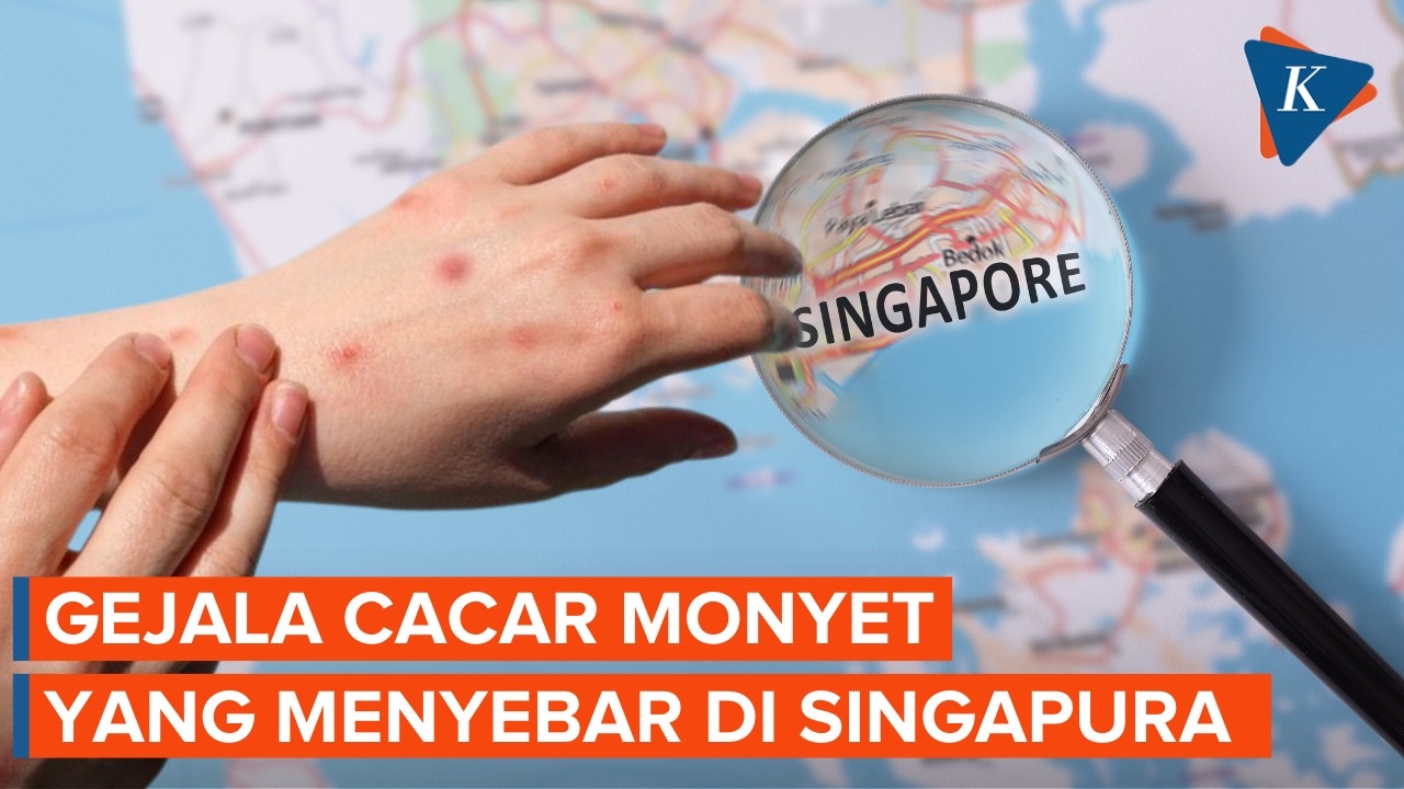 Singapura Konfirmasi Kasus Lokal Cacar Monyet, Begini Gejalanya